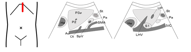 Epigastric longitudinal scanning